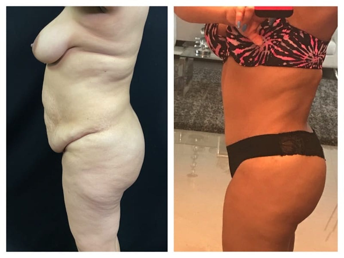 Liposuction Before & After Gallery - Patient 133042312 - Image 2