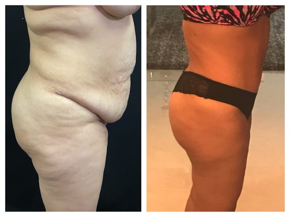 Tummy Tuck Before & After Gallery - Patient 133182983 - Image 3