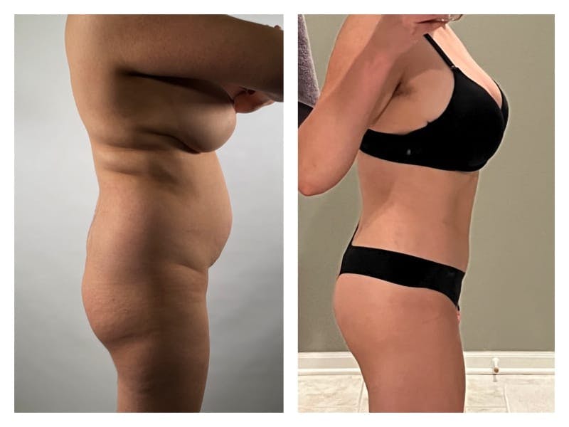 Tummy Tuck Before & After Gallery - Patient 133182986 - Image 2