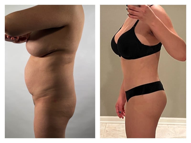 Tummy Tuck Before & After Gallery - Patient 133182986 - Image 3