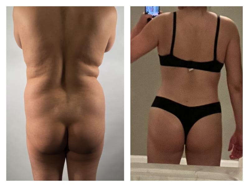 Tummy Tuck Before & After Gallery - Patient 133182986 - Image 4