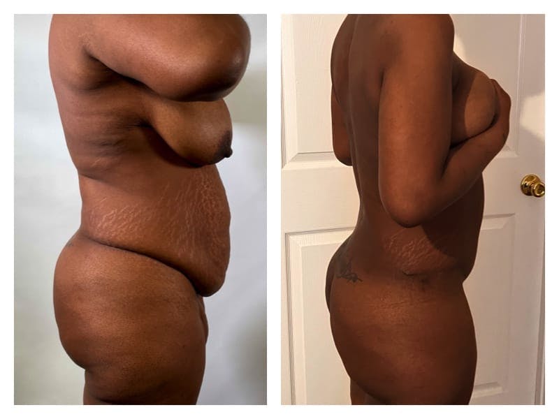 Tummy Tuck Before & After Gallery - Patient 133183848 - Image 4