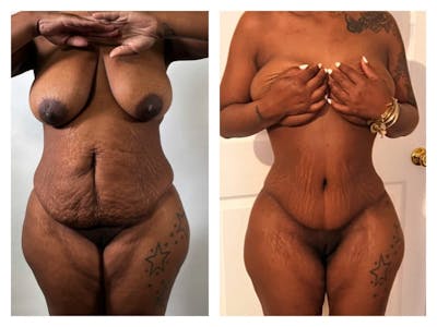 Tummy Tuck Before & After Gallery - Patient 133183848 - Image 1