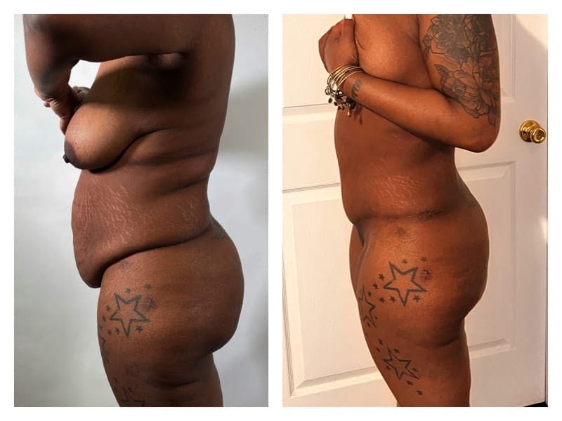 Tummy Tuck Before & After Gallery - Patient 133183848 - Image 3