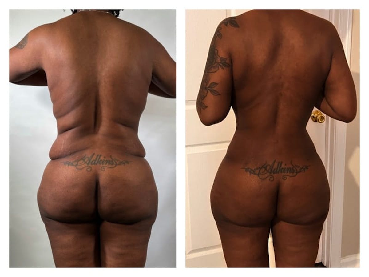 Tummy Tuck Before & After Gallery - Patient 133183848 - Image 2