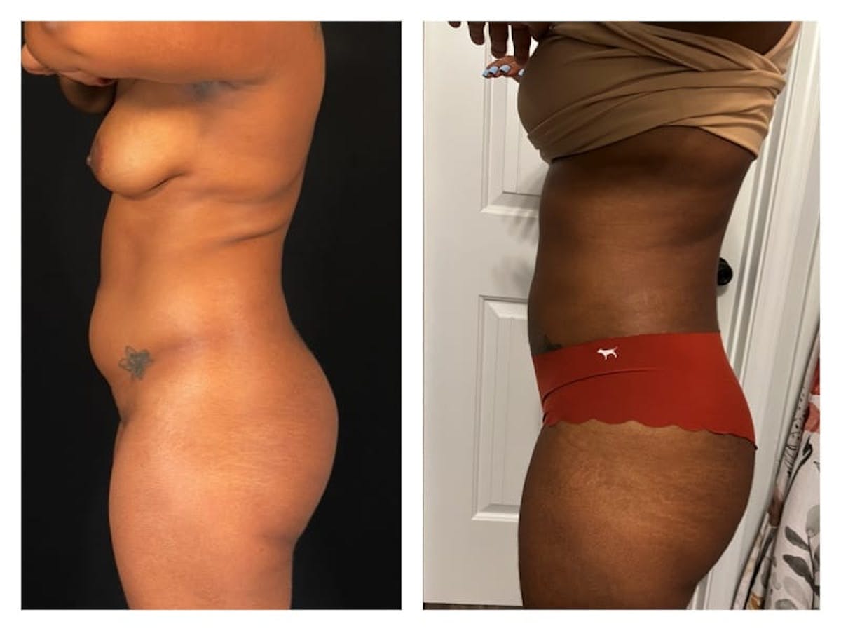 Liposuction Before & After Gallery - Patient 133183910 - Image 4