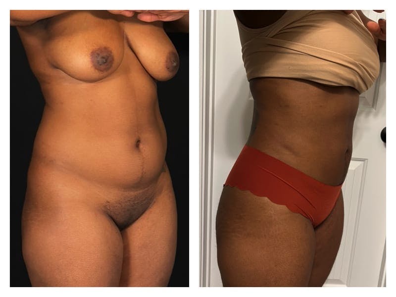 Liposuction Before & After Gallery - Patient 133183910 - Image 3
