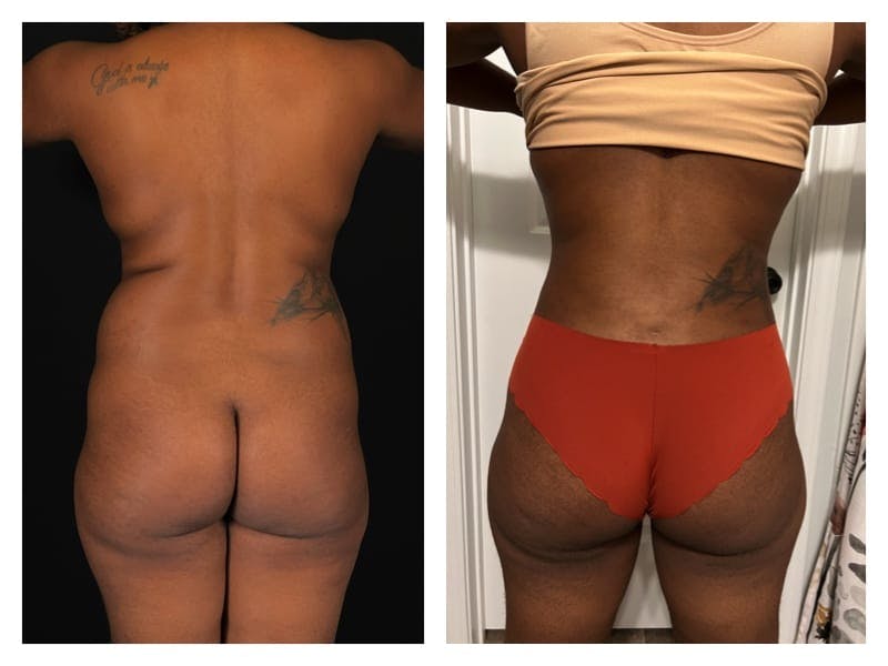 Liposuction Before & After Gallery - Patient 133183910 - Image 2