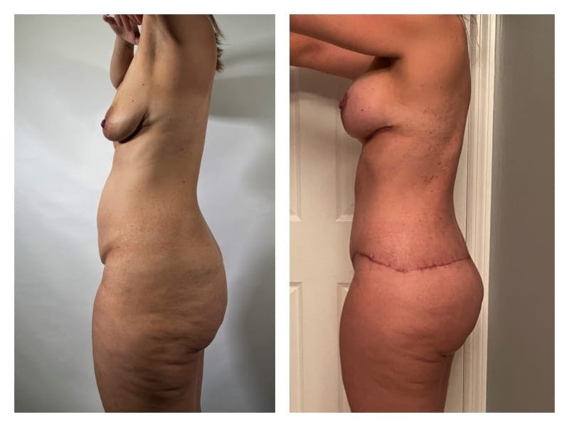 Mommy Makeover Before & After Gallery - Patient 133183903 - Image 3