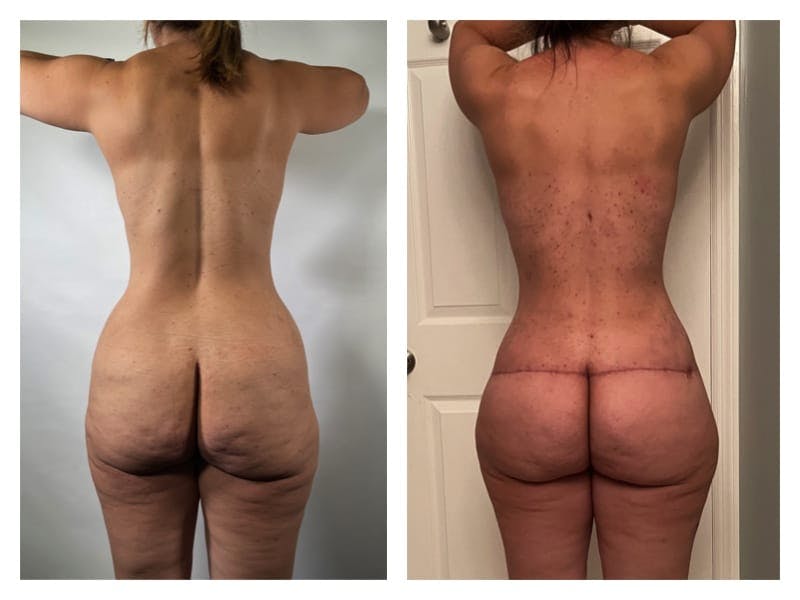 Mommy Makeover Before & After Gallery - Patient 133183903 - Image 2