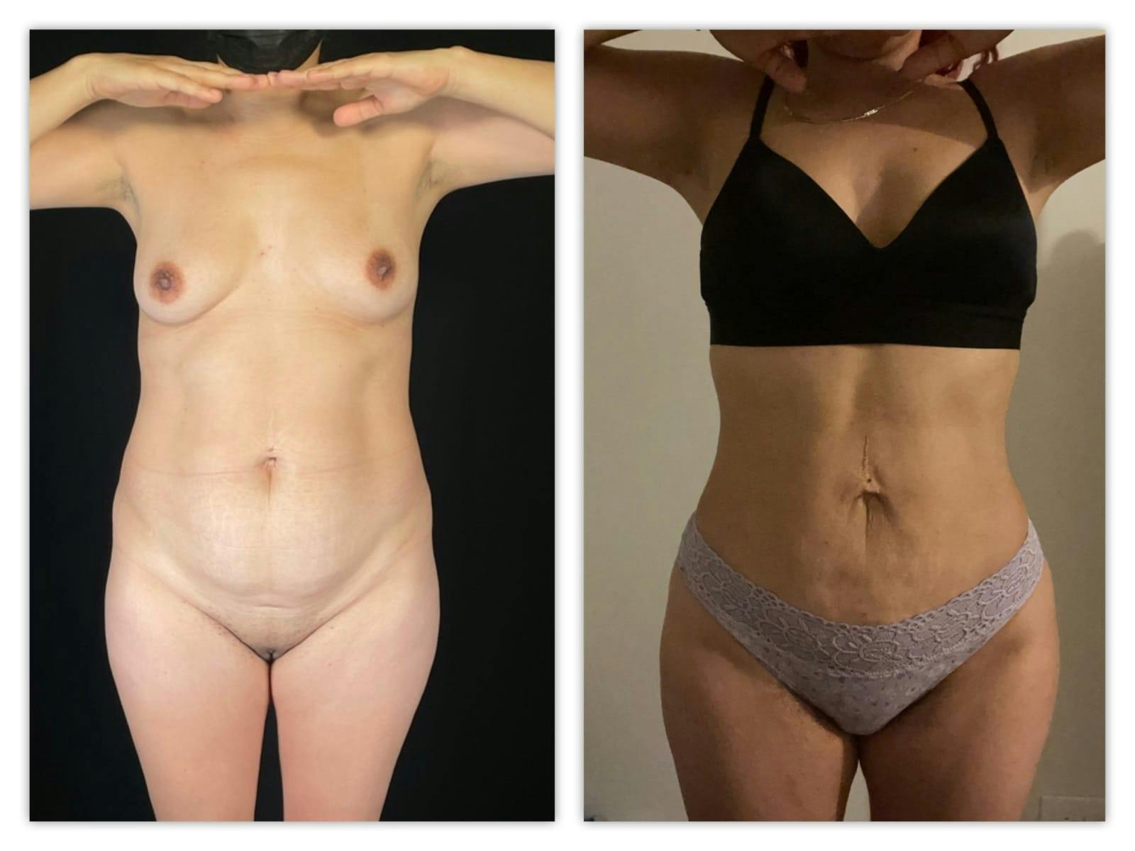 Liposuction Before & After Gallery - Patient 133183927 - Image 1