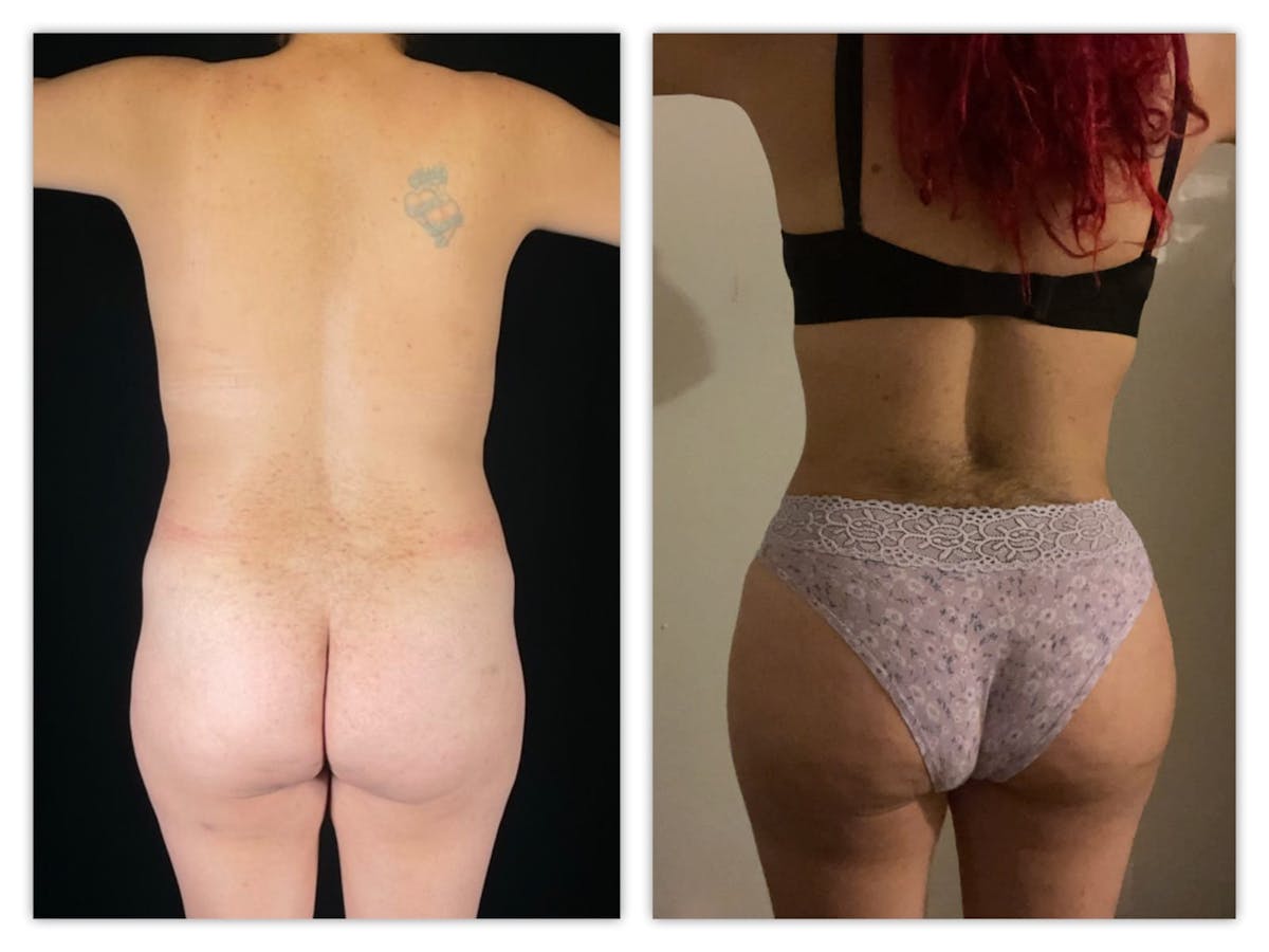 Brazilian Butt Lift Before & After Gallery - Patient 133183922 - Image 1