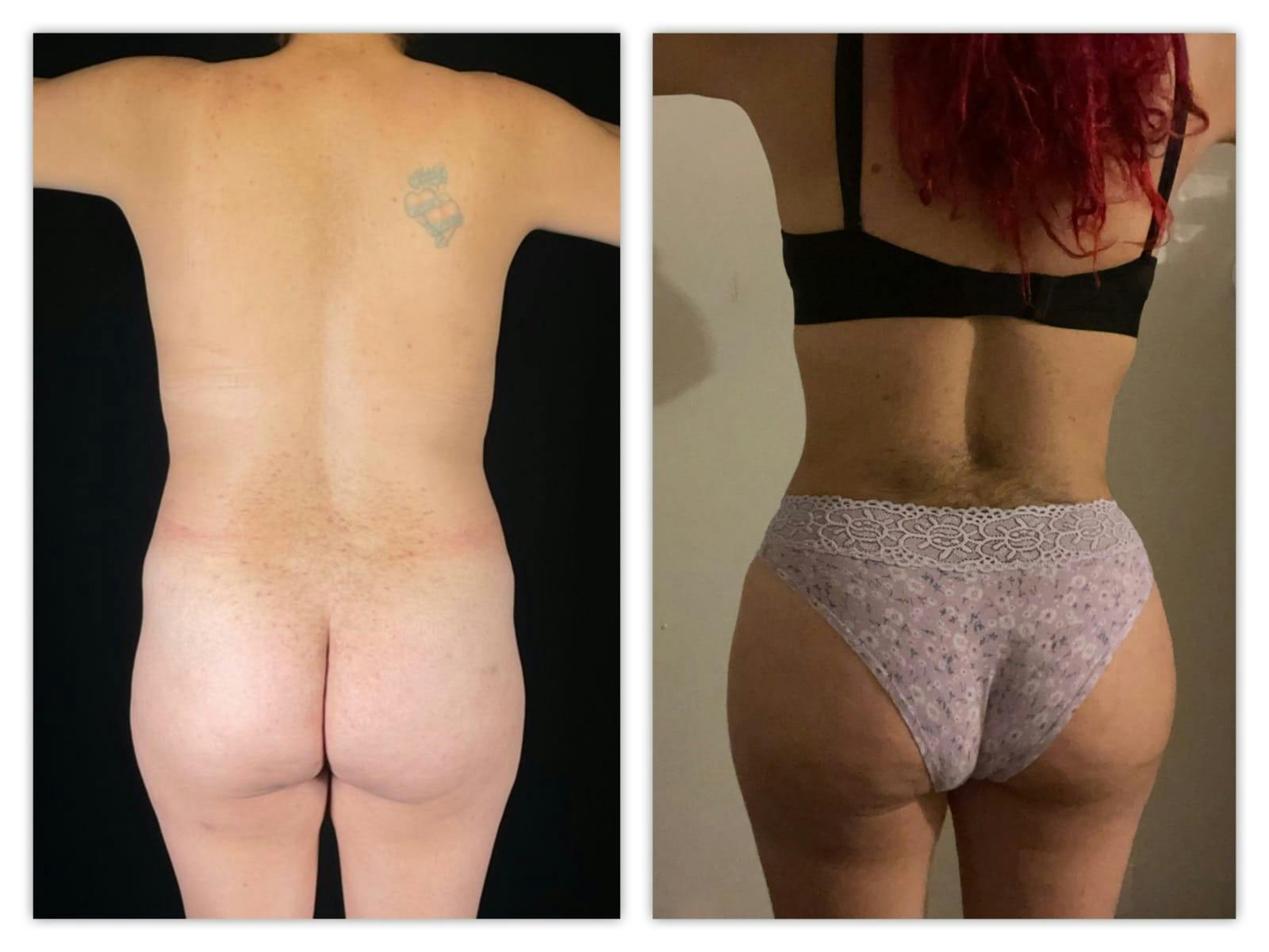 Liposuction Before & After Gallery - Patient 133183927 - Image 3