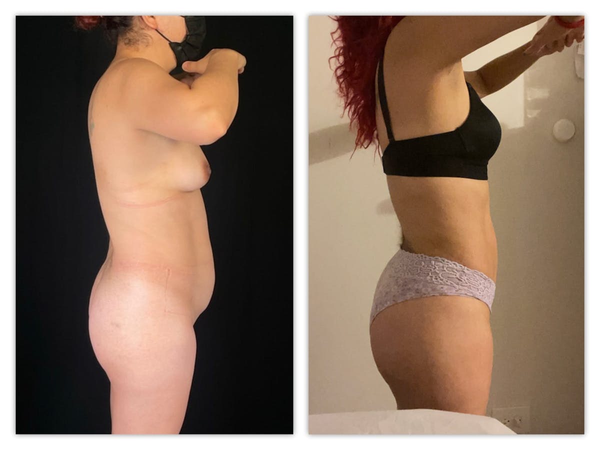 Brazilian Butt Lift Before & After Gallery - Patient 133183922 - Image 2