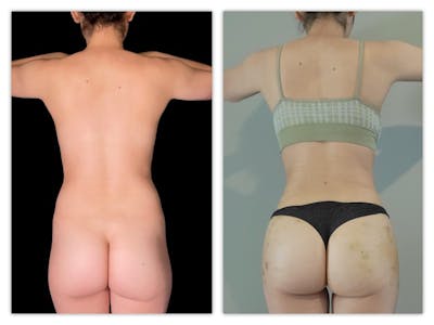 Brazilian Butt Lift Before & After Gallery - Patient 133183832 - Image 1