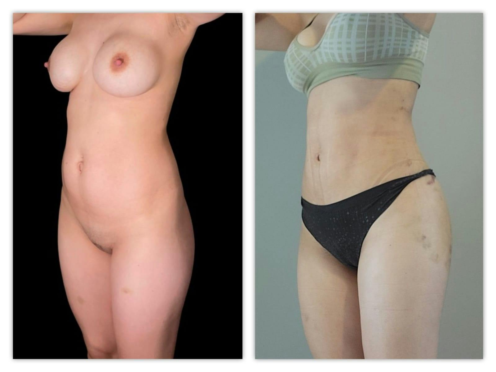 Brazilian Butt Lift Before & After Gallery - Patient 133183832 - Image 2