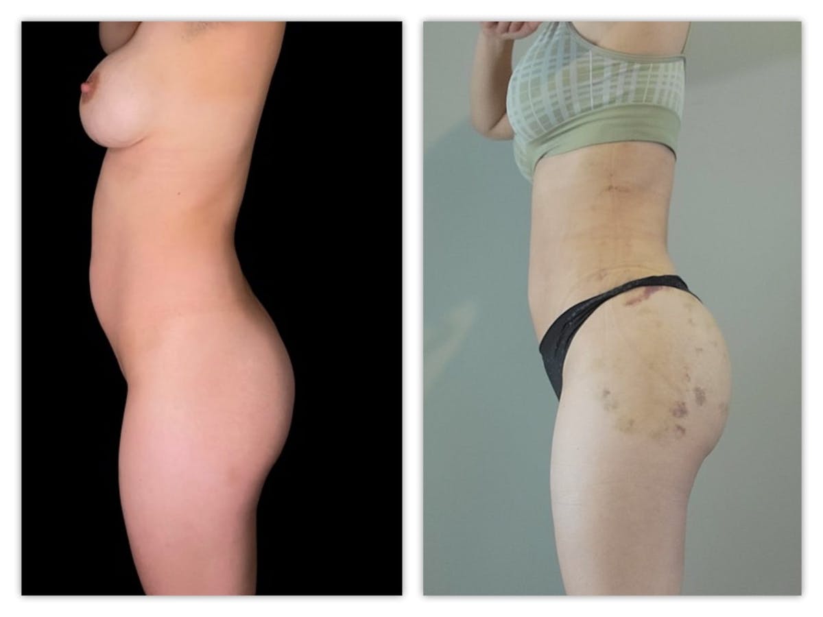 Brazilian Butt Lift Before & After Gallery - Patient 133183832 - Image 2