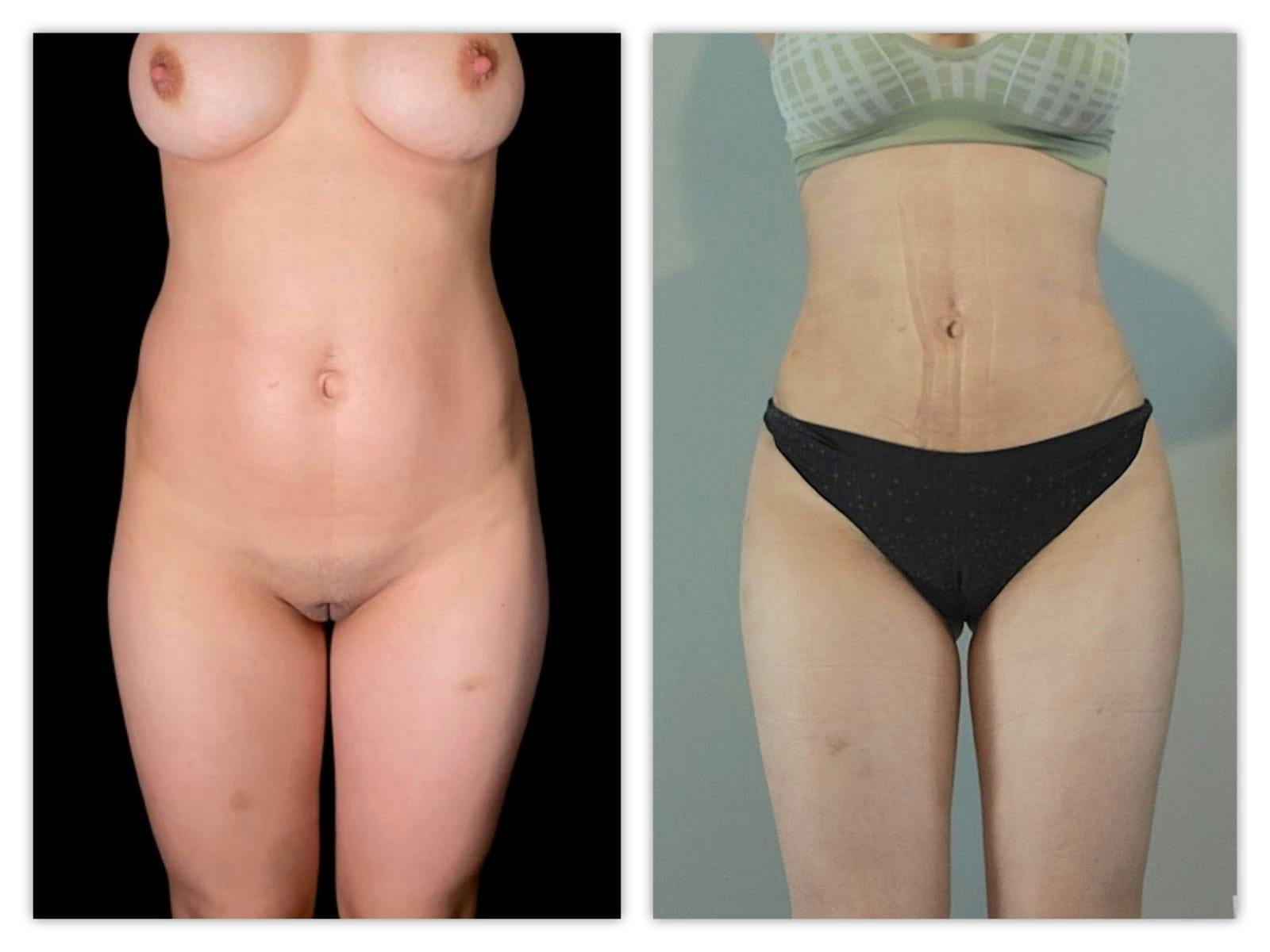 Brazilian Butt Lift Before & After Gallery - Patient 133183832 - Image 4