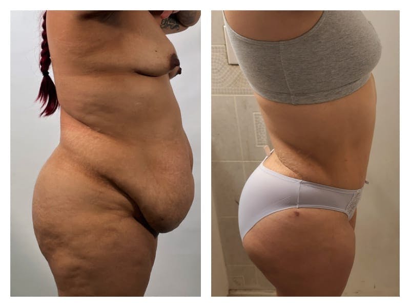Liposuction Before & After Gallery - Patient 133183860 - Image 4