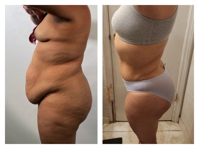 Liposuction Before & After Gallery - Patient 133183860 - Image 3