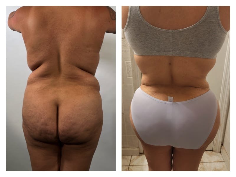 Liposuction Before & After Gallery - Patient 133183860 - Image 2