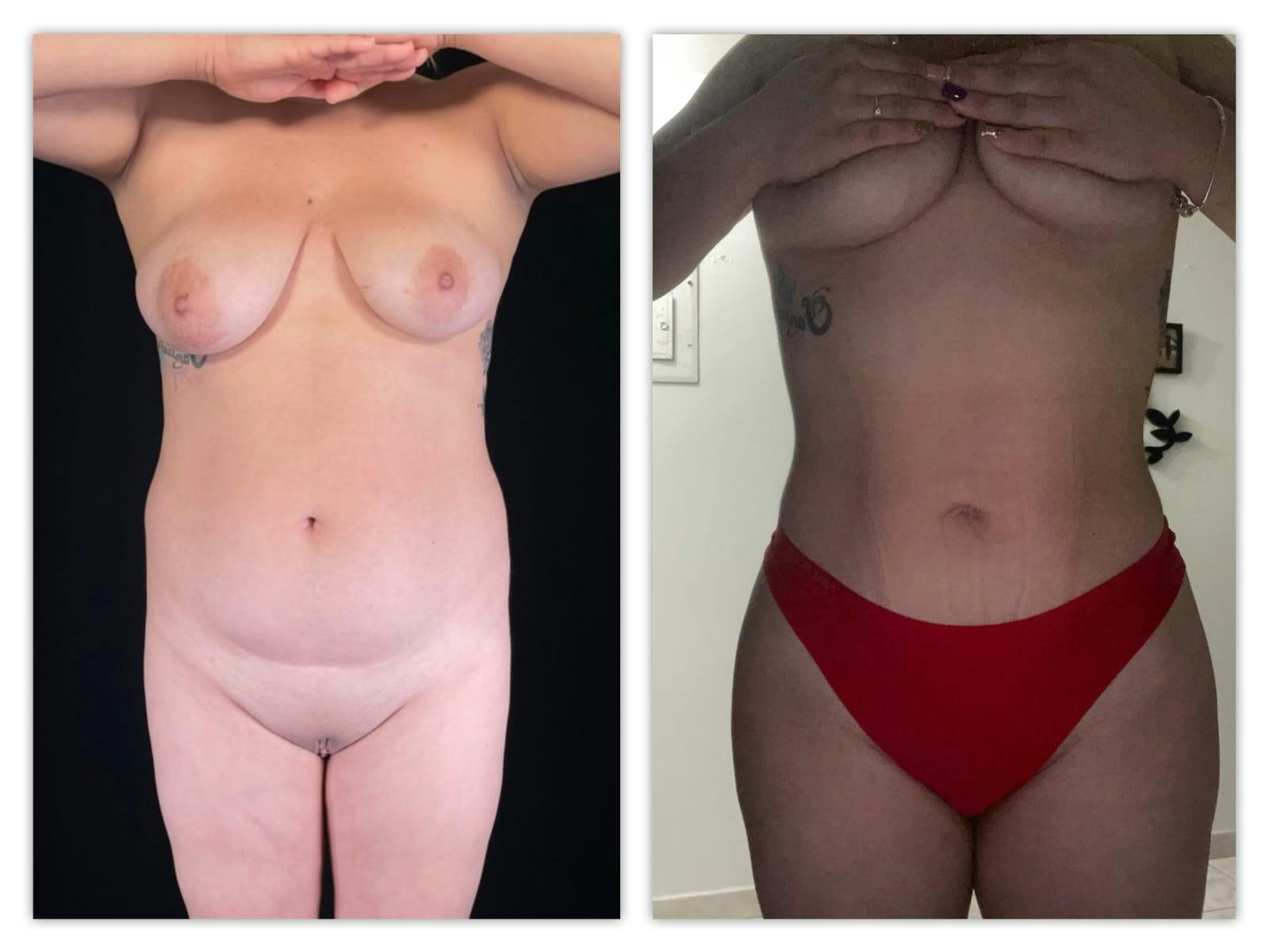 Liposuction Before & After Gallery - Patient 133183921 - Image 4
