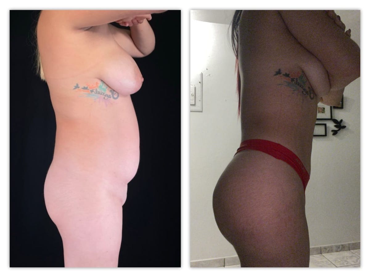 Liposuction Before & After Gallery - Patient 133183921 - Image 4