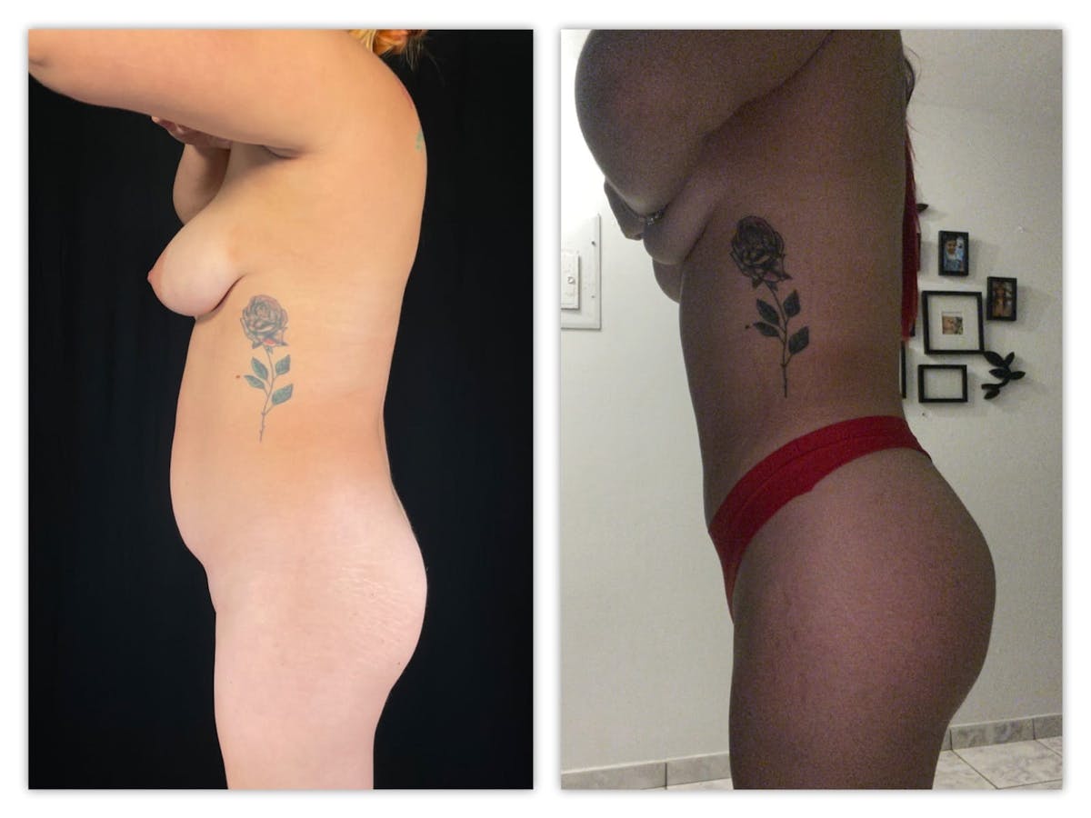 Liposuction Before & After Gallery - Patient 133183921 - Image 3