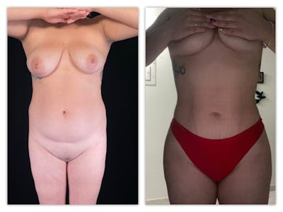 Liposuction Before & After Gallery - Patient 133183921 - Image 1