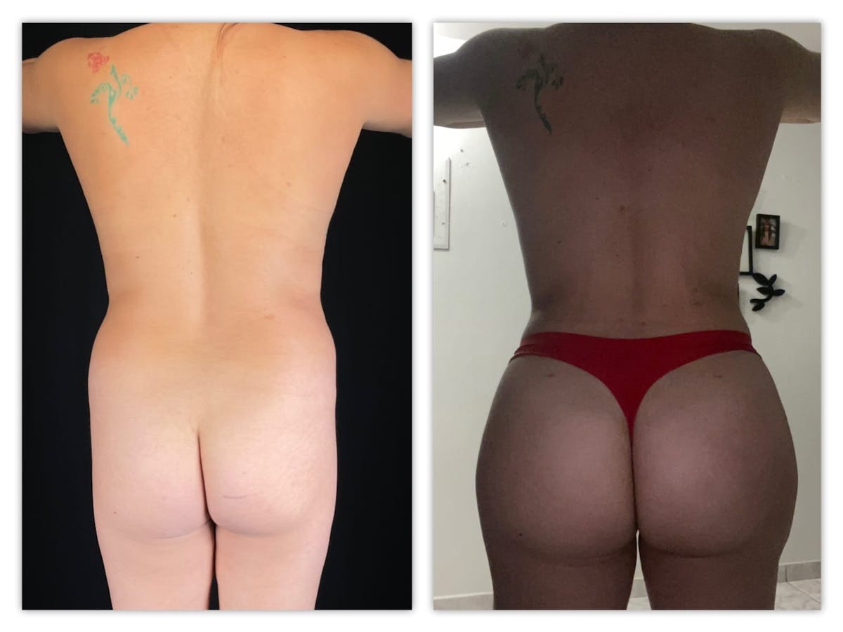 Liposuction Before & After Gallery - Patient 133183921 - Image 2