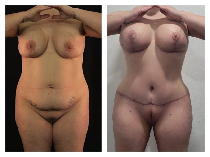 Mommy Makeover Before & After Gallery - Patient 133183861 - Image 1