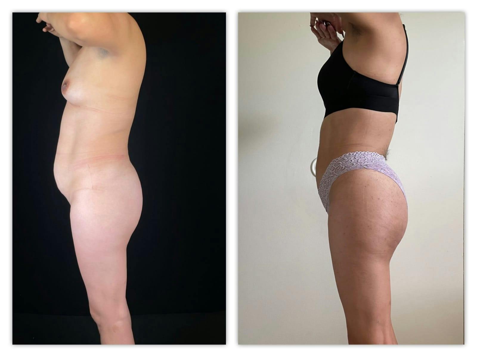 Brazilian Butt Lift Before & After Gallery - Patient 133183928 - Image 3