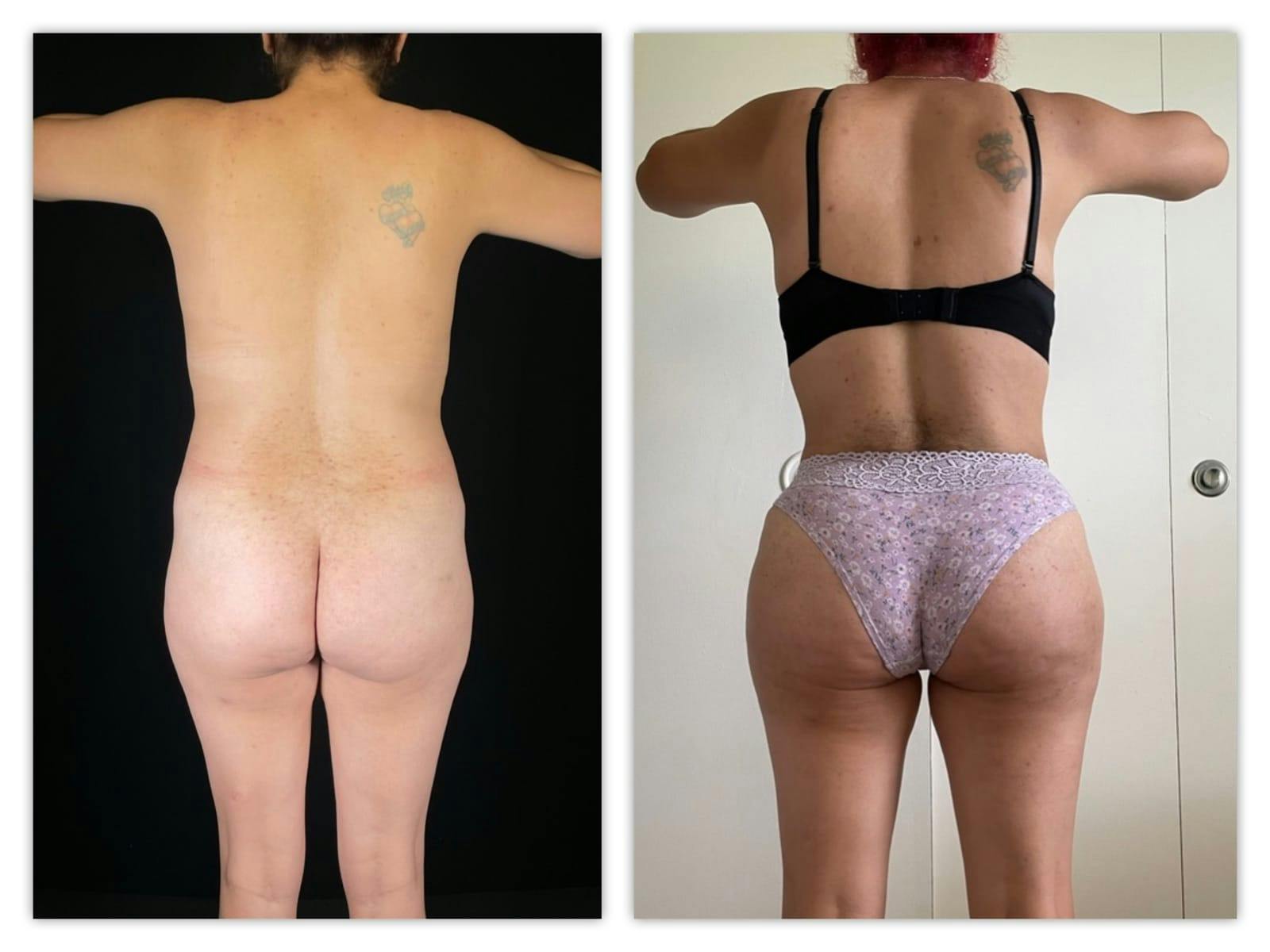 Liposuction Before & After Gallery - Patient 133183926 - Image 4