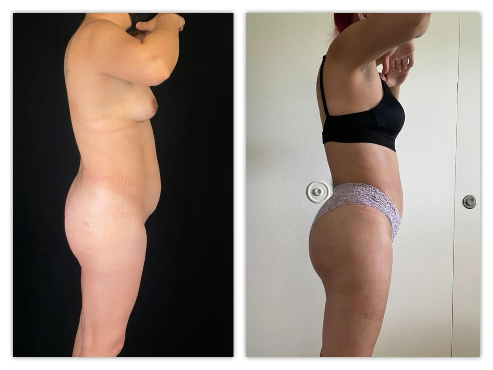 Brazilian Butt Lift Before & After Gallery - Patient 133183928 - Image 2