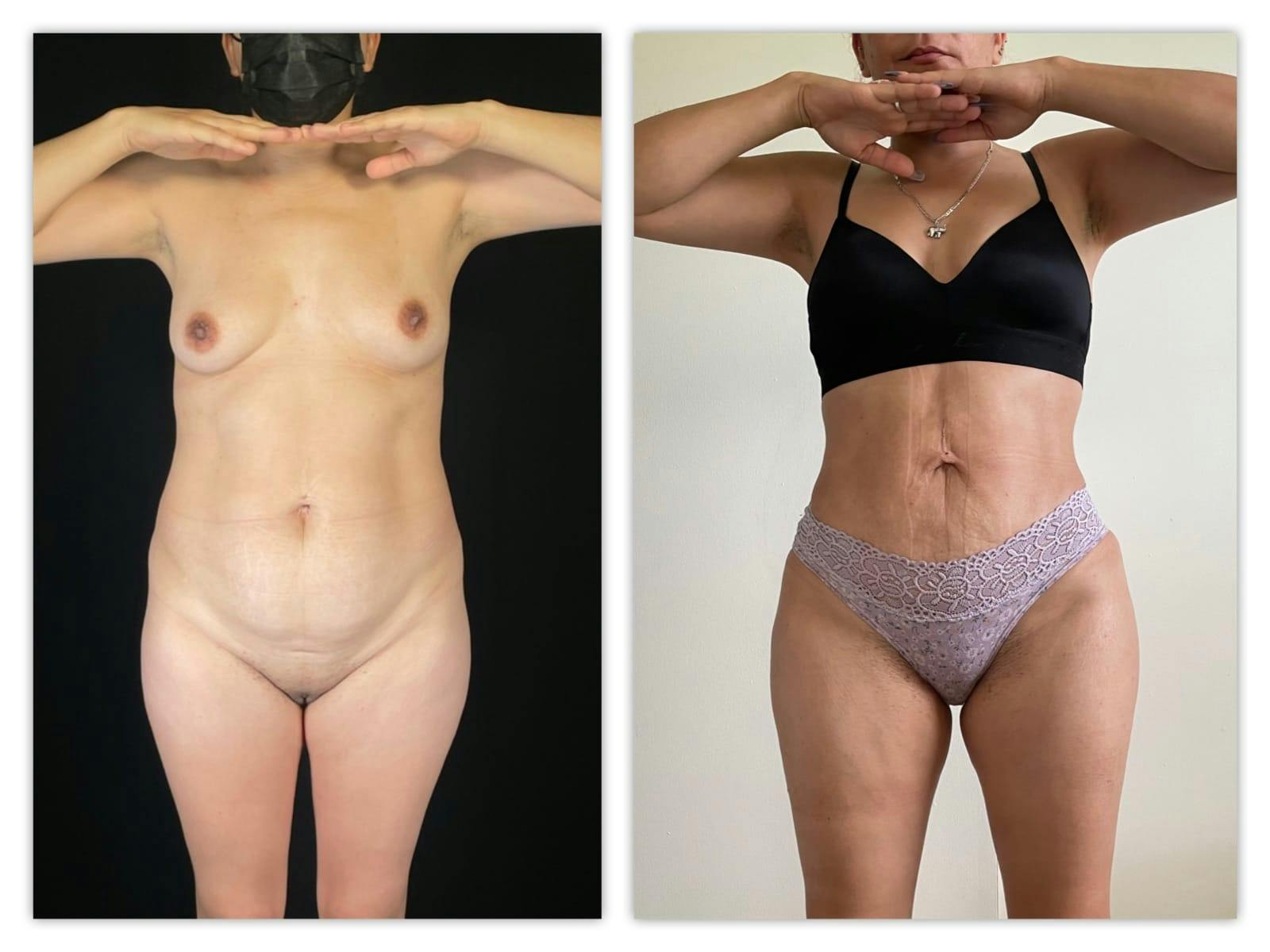 Brazilian Butt Lift Before & After Gallery - Patient 133183928 - Image 4