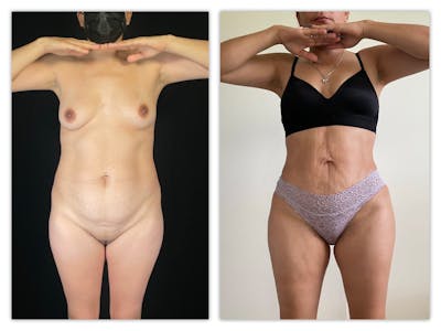 Liposuction Before & After Gallery - Patient 133183926 - Image 1
