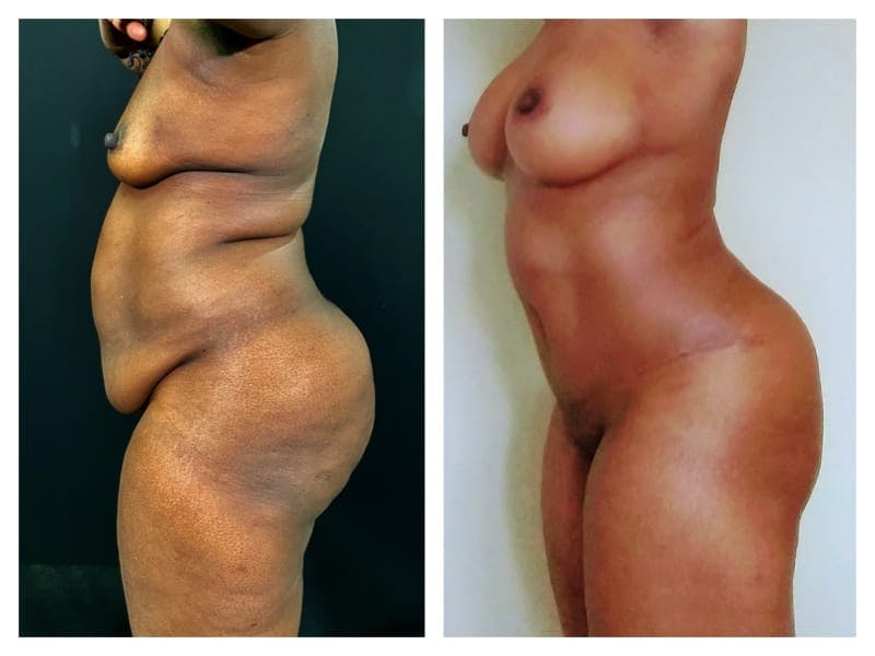 Mommy Makeover Before & After Gallery - Patient 133183833 - Image 3
