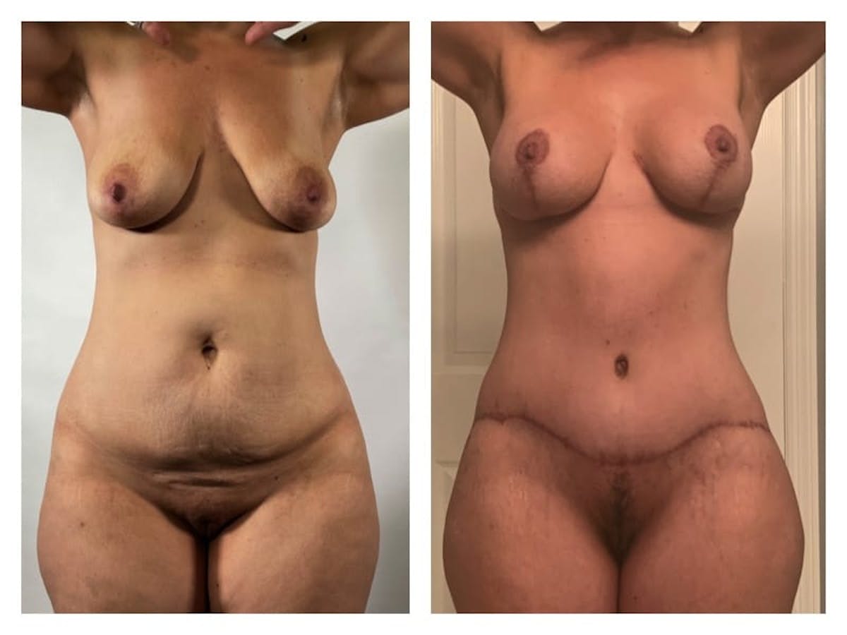 Mommy Makeover Before & After Gallery - Patient 133183906 - Image 1