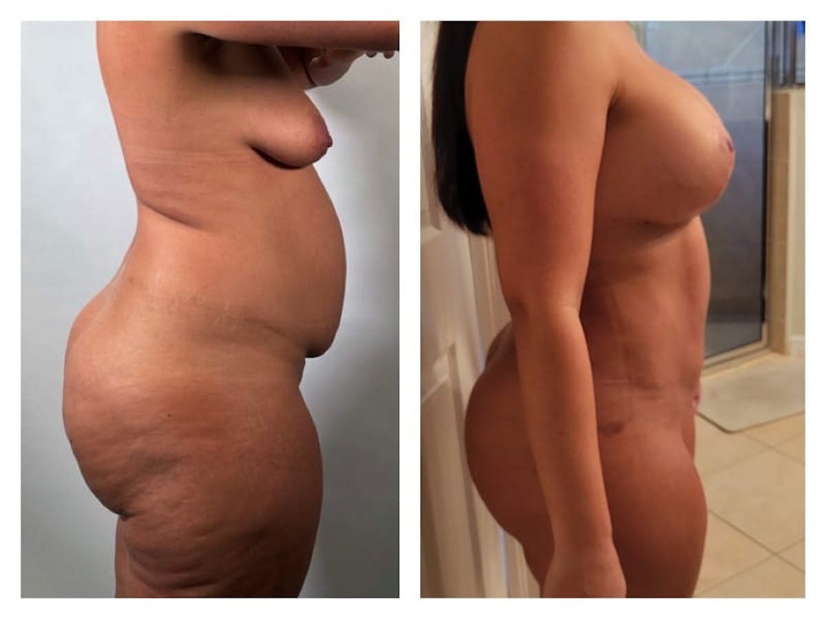 Liposuction Before & After Gallery - Patient 133183845 - Image 4