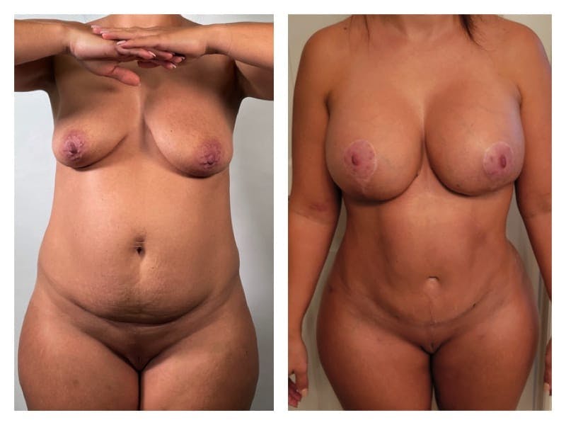 Liposuction Before & After Gallery - Patient 133183845 - Image 1