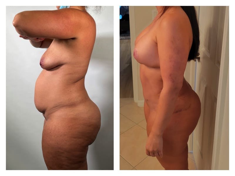 Liposuction Before & After Gallery - Patient 133183845 - Image 3