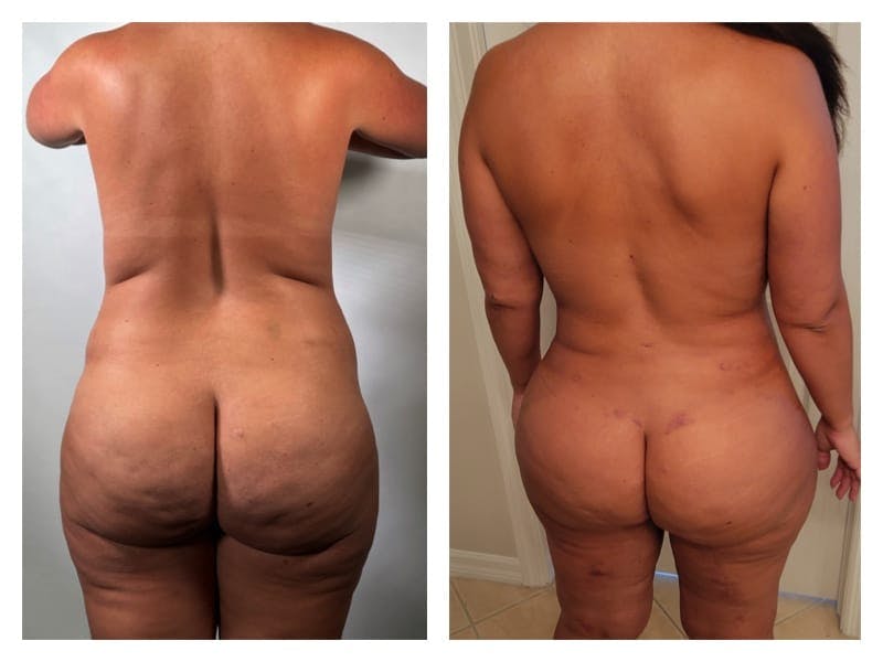 Liposuction Before & After Gallery - Patient 133183845 - Image 2