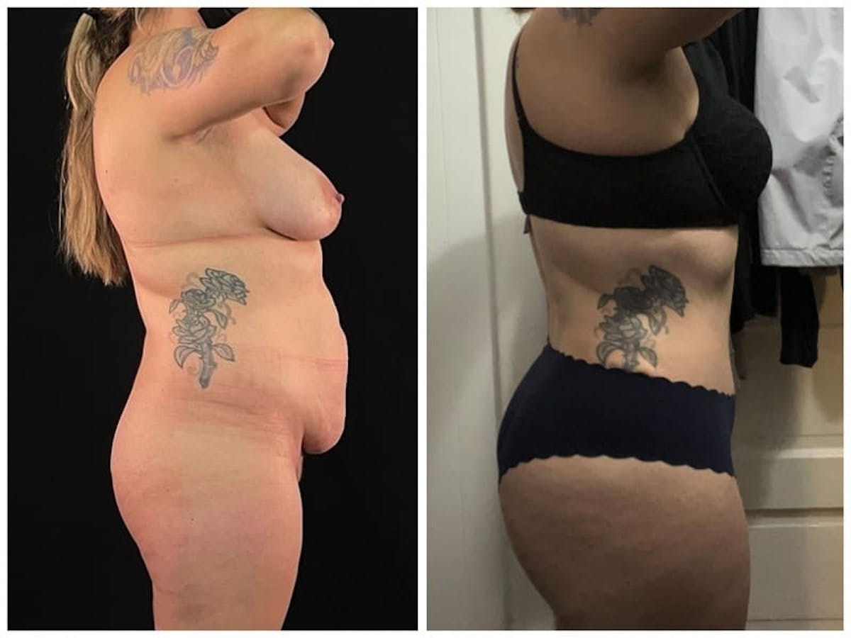 Brazilian Butt Lift Before & After Gallery - Patient 133183794 - Image 2