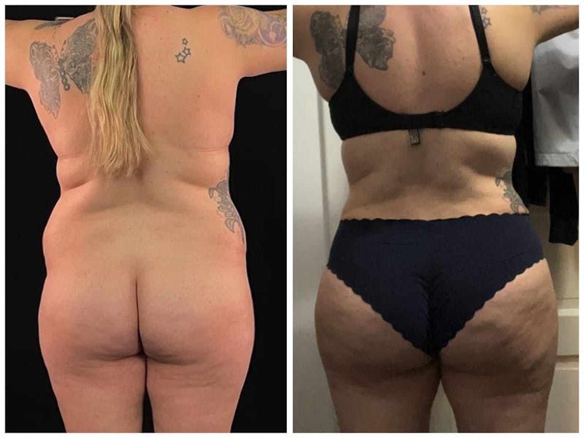 Tummy Tuck Before & After Gallery - Patient 133183792 - Image 2