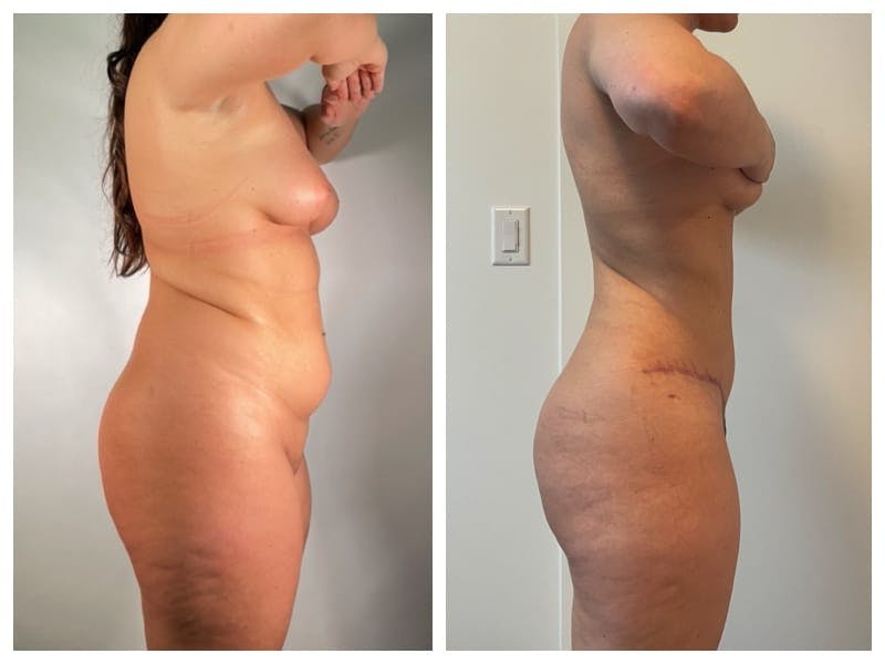 Tummy Tuck Before & After Gallery - Patient 133183659 - Image 4