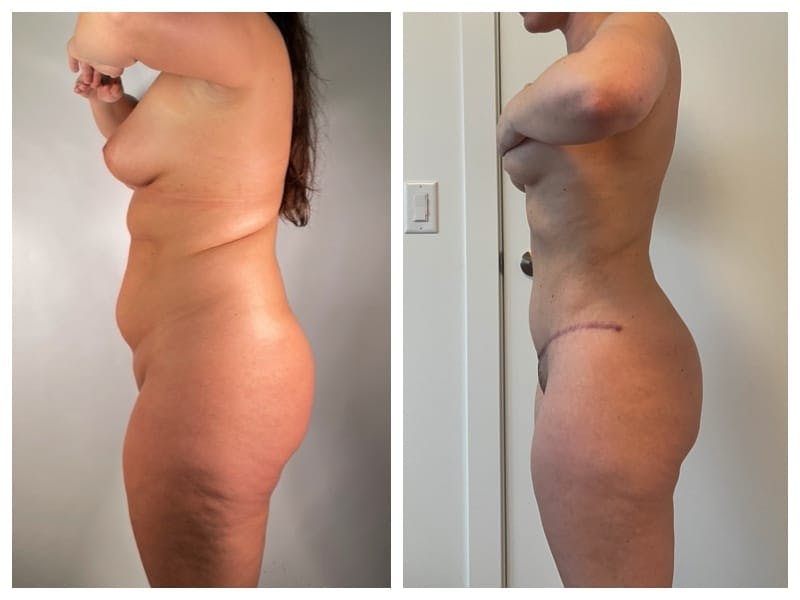 Tummy Tuck Before & After Gallery - Patient 133183659 - Image 3