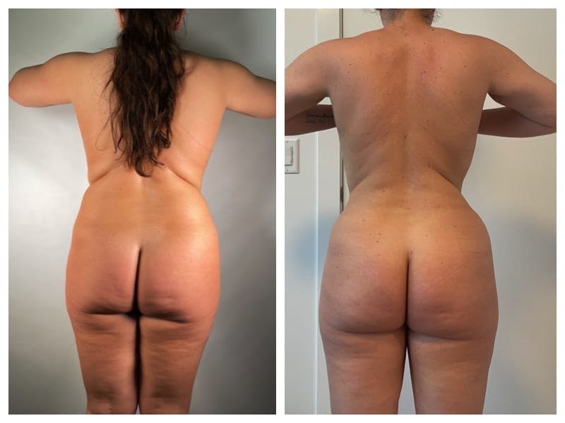 Tummy Tuck Before & After Gallery - Patient 133183659 - Image 2