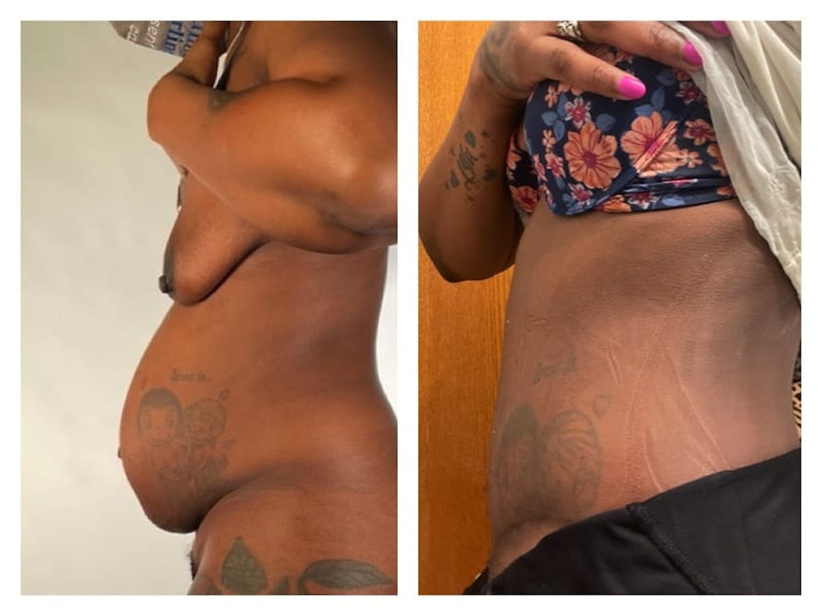 Tummy Tuck Before & After Gallery - Patient 133183654 - Image 2