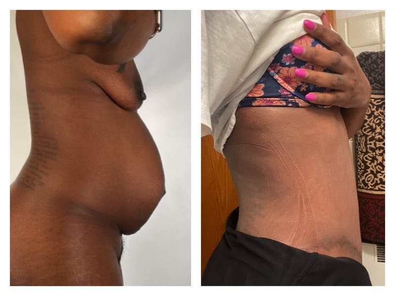 Tummy Tuck Before & After Gallery - Patient 133183654 - Image 3