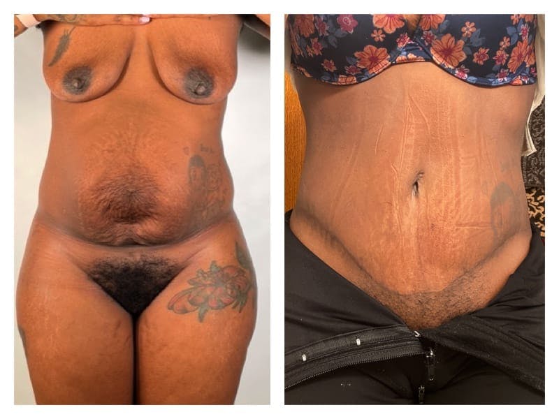 Tummy Tuck Before & After Gallery - Patient 133183654 - Image 1